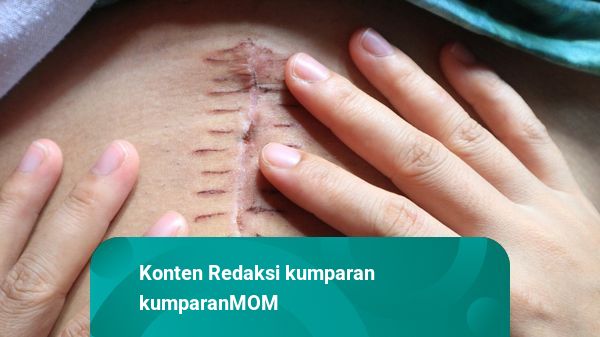 Jahitan Operasi Caesar Sakit, Wajar atau Bahaya? | kumparan.com